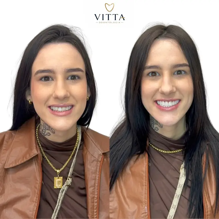 Antes e depois de lentes de resina, paciente da Vitta