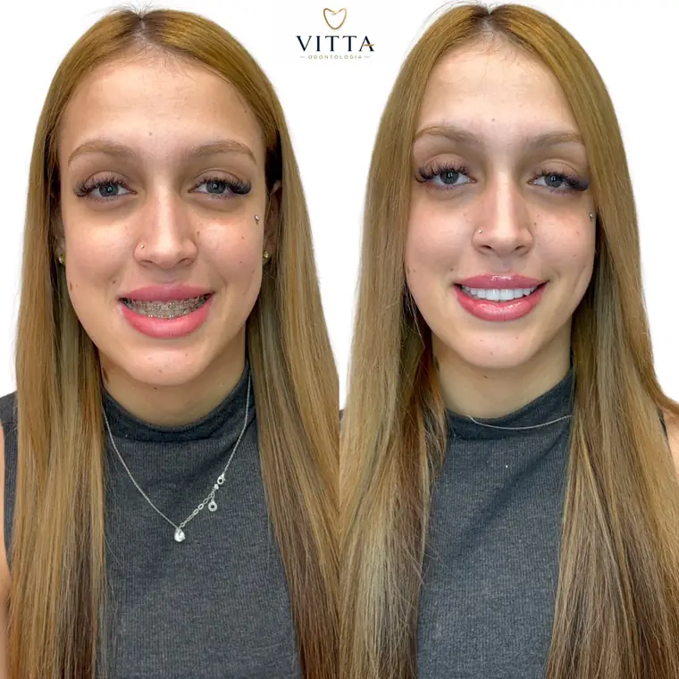 Antes e depois de lentes de resina, paciente da Vitta